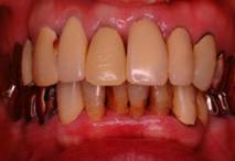 お薬で治す歯周病の症例 治療後3