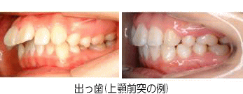 出っ歯（上顎前突の例