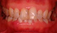 お薬で治す歯周病の症例 治療前2