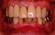 お薬で治す歯周病の症例 治療前3