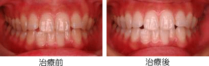 菊地歯科　ホワイトニングの症例