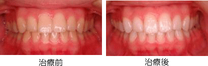 菊地歯科　ホワイトニングの症例